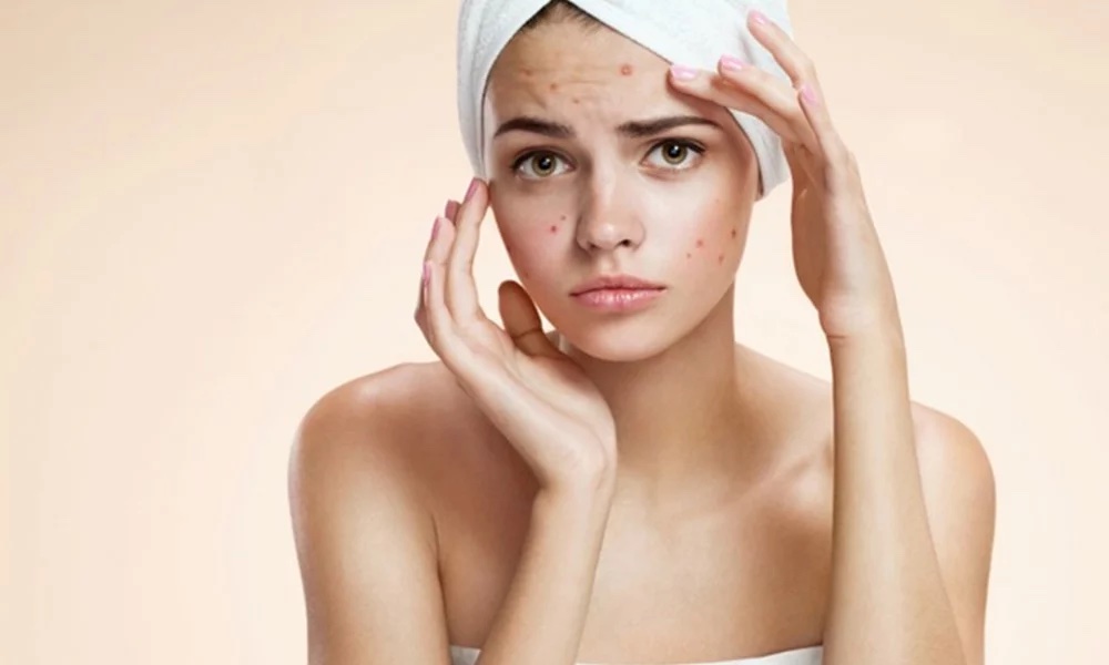preguntas sobre el acne 1000x600w